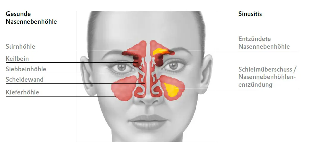 Grafik-Sinusitis-Nasennebenhoelenentzuendung.jpg