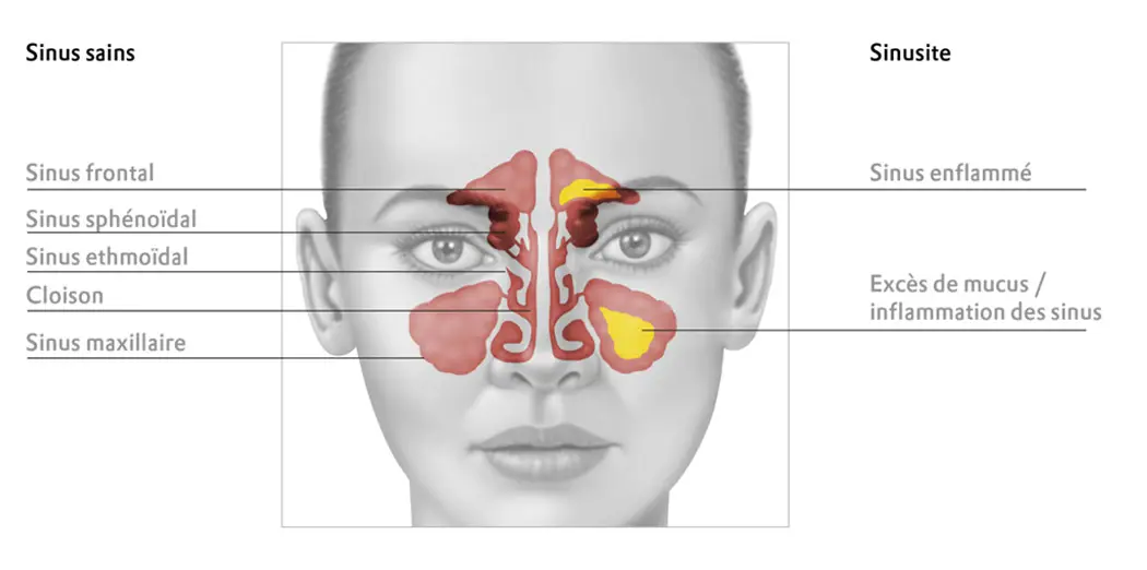 Grafik-sinusite-Inflammation-des-sinus.jpg