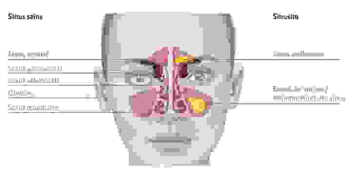 Grafik-sinusite-Inflammation-des-sinus.jpg